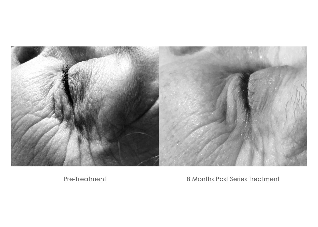Before and After 8 Months Treatment