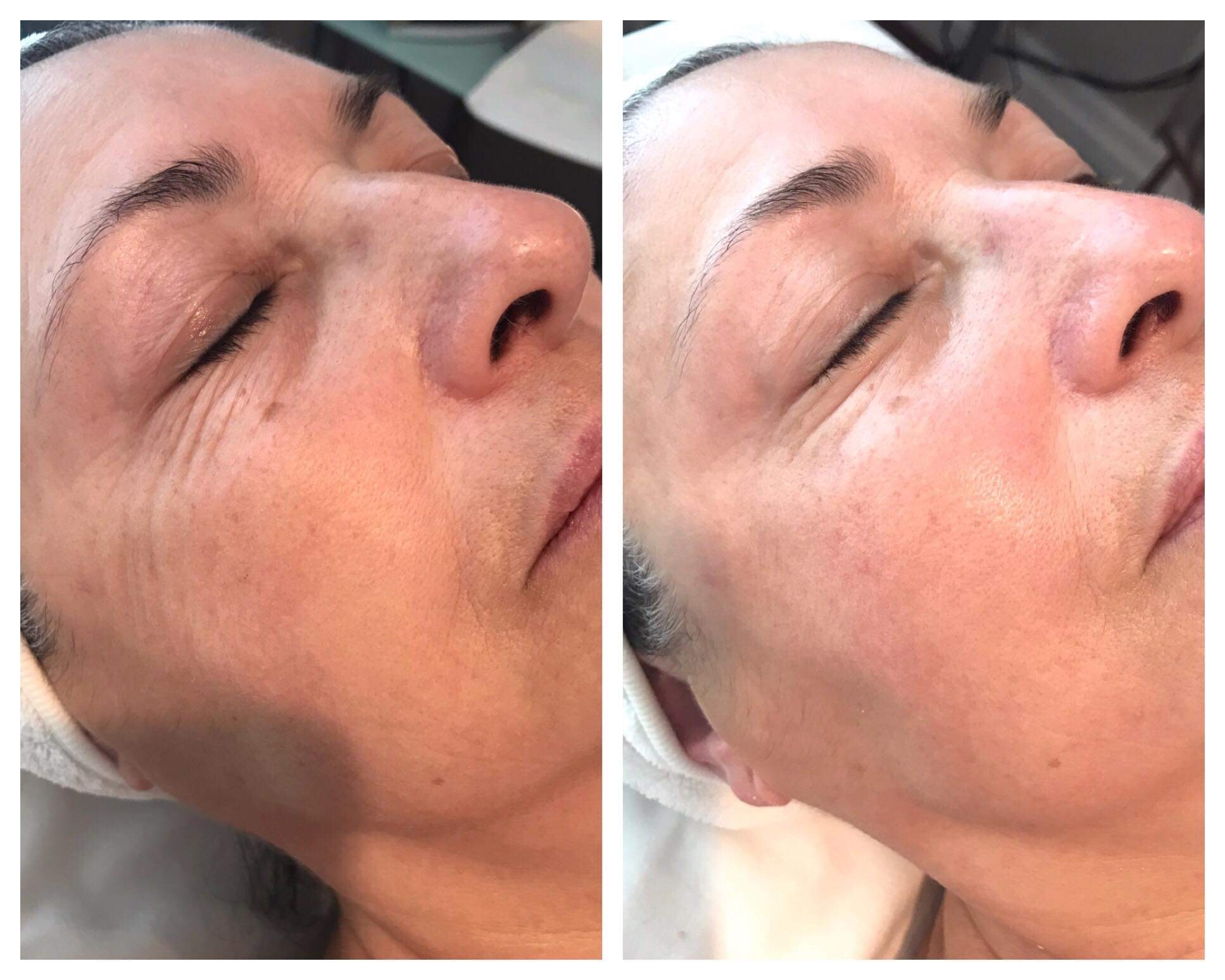 Before and After Nano Needling