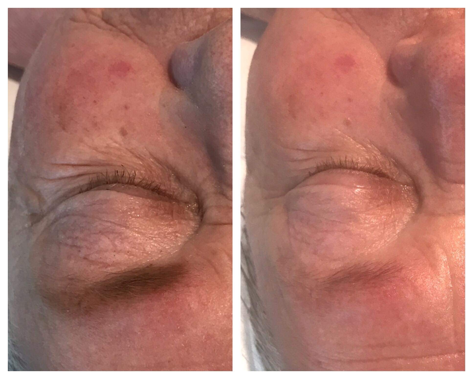 Before and After Nano Needling. Reduction in skin pigmenation.