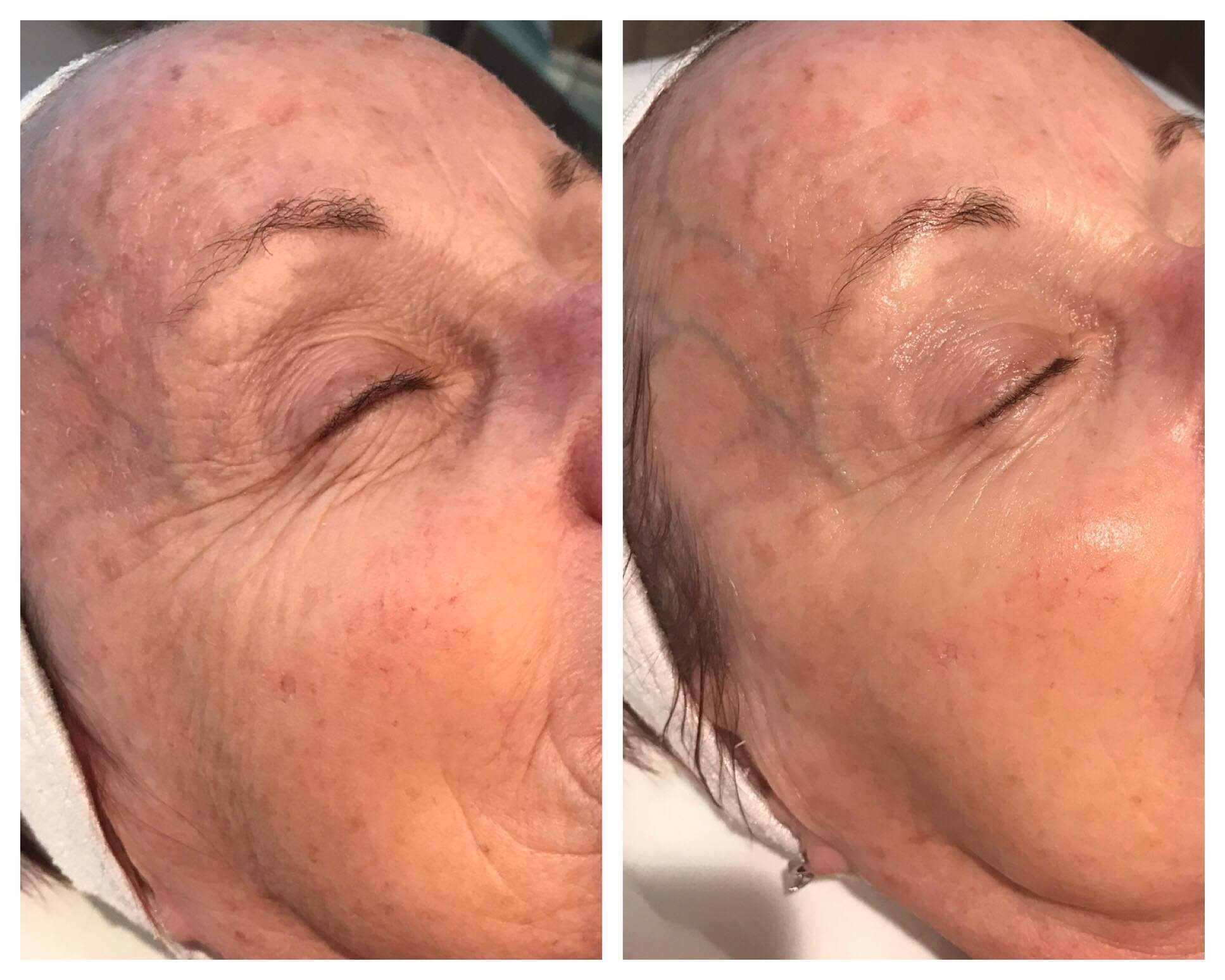 Before and After Nano Needling. Reduction of wrinkles.