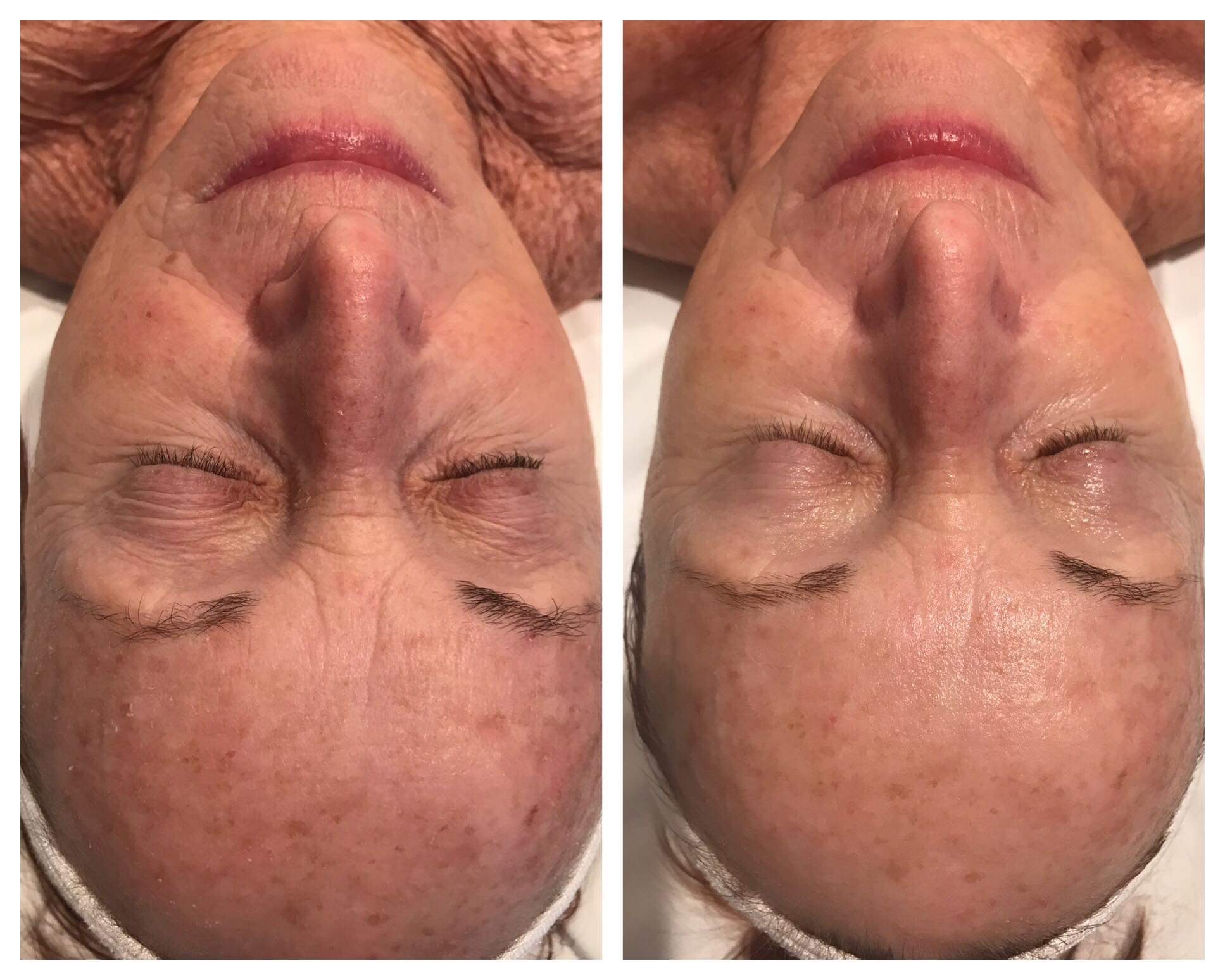 Before and After Nano Needling. Skin improvement.