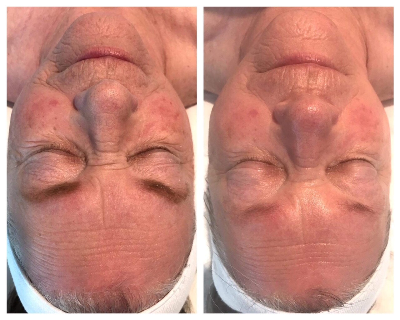 Before and After Nano Needling. Improve skin texture.