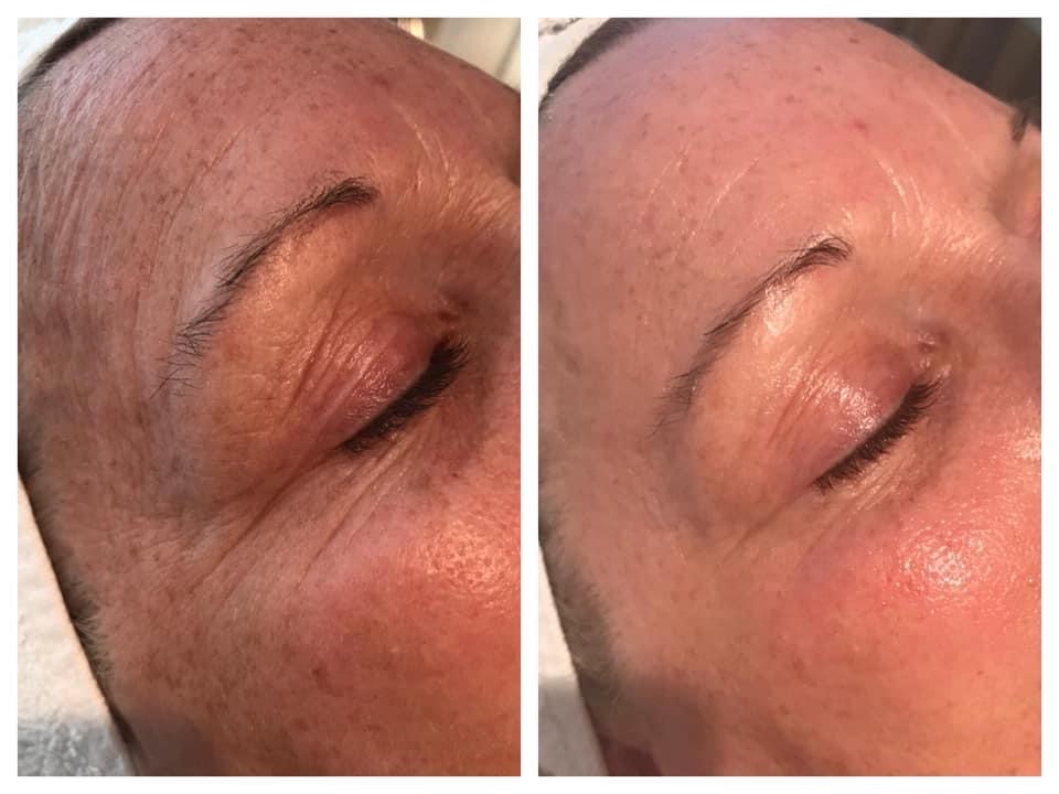 Before and After Nano Needling. Smoother skin!