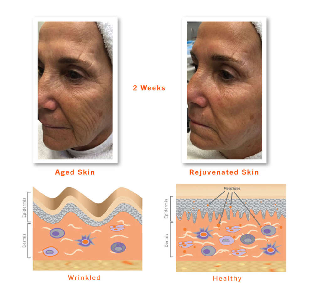 Nano Needling Infusion | Palm and Cedar Wellness Clinic Parksville