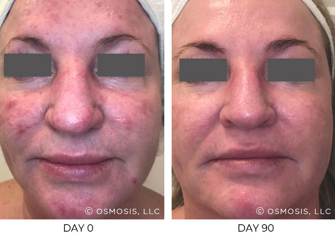 Before and after 90 days of Osmosis facial infusion therapy.