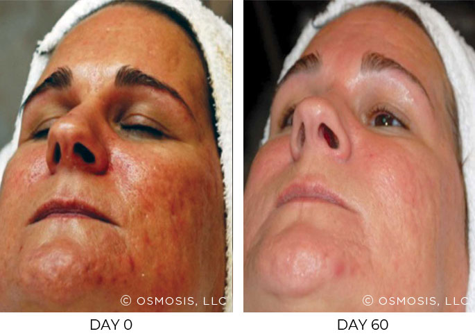 Before and after 60 days of Osmosis facial infusion therapy.