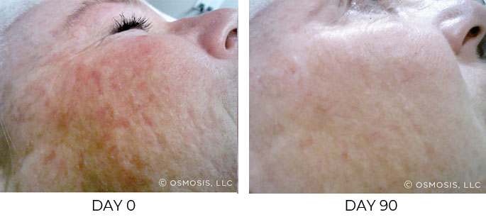 Before and after 90 days of Osmosis infusion therapy on cheeks.