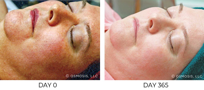 Before and after 1 year of Osmosis facial infusion therapy.