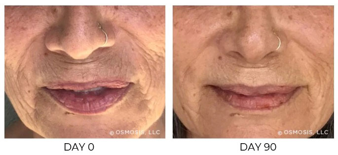 Before and after 90 days of Osmosis facial infusion therapy.