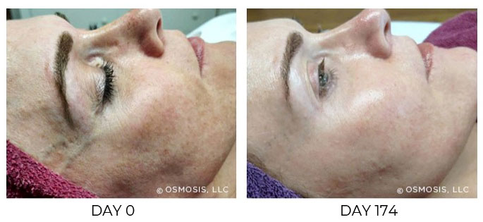 Before and after 174 days of Osmosis facial infusion therapy.