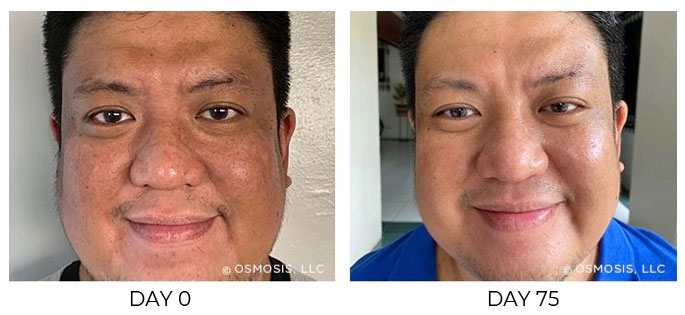 Before and after 75 days of Osmosis facial infusion therapy.