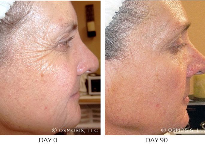 Before and after 90 days of Osmosis facial infusion therapy.