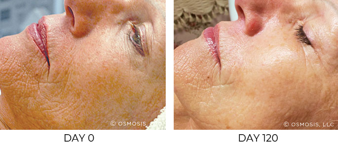 Before and after 120 days of Osmosis facial infusion therapy.