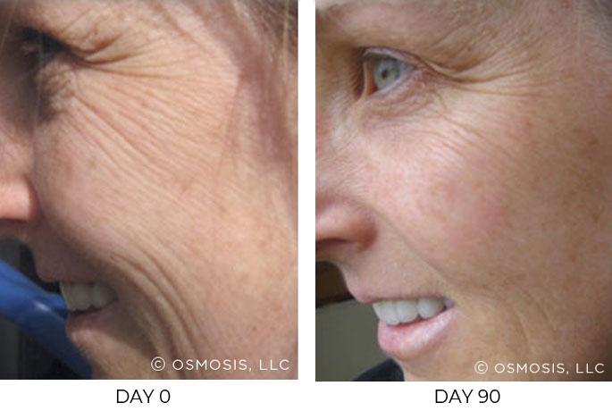 Smoother skin after 90 days of Osmosis facial infusion therapy.