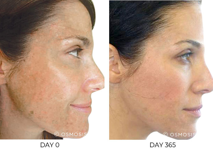 Before and after 365 days of Osmosis facial infusion therapy.