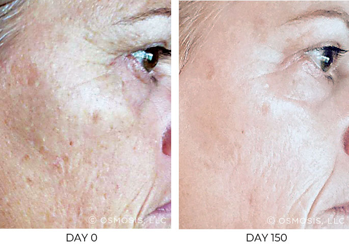 Before and after 150 days of Osmosis facial infusion therapy.