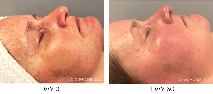 Before and after 60 days of Osmosis facial infusion therapy.