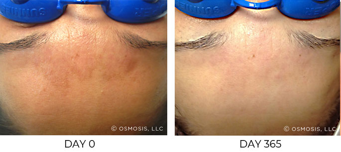 Before and after 365 days of Osmosis facial infusion therapy.