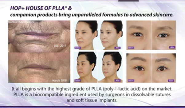 HOP + PLLA Mask treatement before and after images